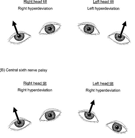 Figure From Vertical Misalignment In Unilateral Sixth Nerve Palsy