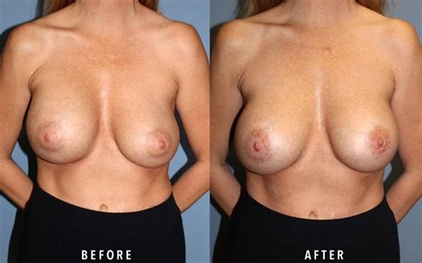 Breast Revision Archives The Woodlands Plastic Surgery