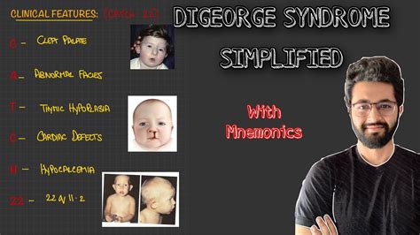 Digeorge Syndrome Etiopathogenesis Clinical Features Diagnosis And