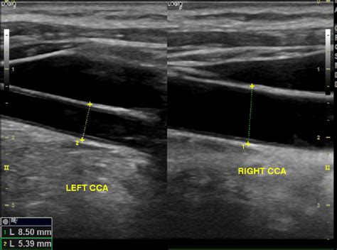 Mode B Ultrasonography Images Showing The Left Common Carotid Artery