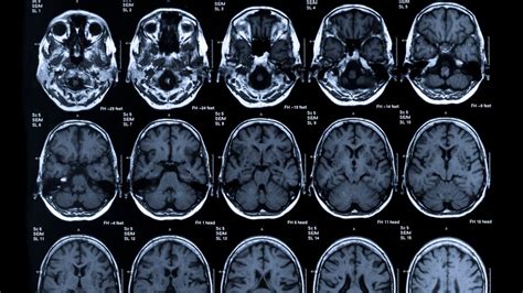 Neuroimaging Techniques And What A Brain Image Can Tell Us Technology