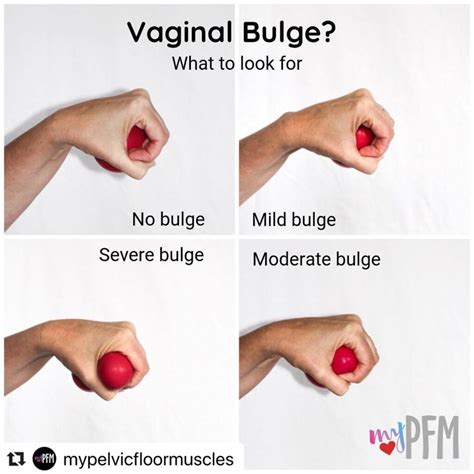 stages of pelvic organ prolapse