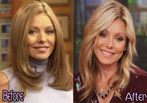 Kelly Ripa Plastic Surgery Botox Before And After Plastic Surgery