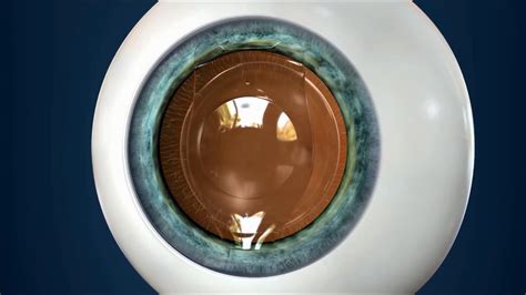 Clear Lens Implants An Alternative To Lasik The Yaldo Eye Center