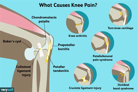 Why does my knee hurt when i bend it? Knee pain, causes, and treatment: Read full report here ...