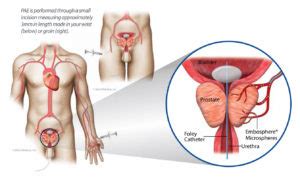 Men Have A New Minimally Invasive Treatment Option For Enlarged Prostate Radiology Medical