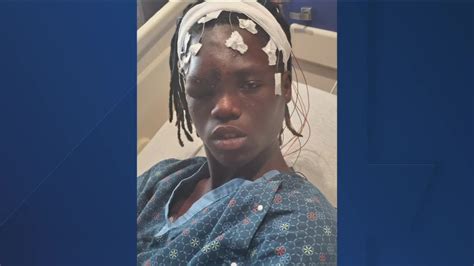 Mom Speaks After Teen Son Shot With Rubber Bullet
