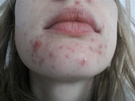 Cystic Chin Acne General Acne Discussion Forum