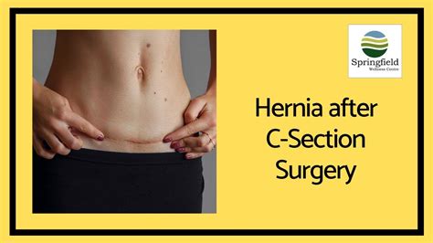Hernia After C Section Surgery Dr Maran Talks About Incisional Hernia After Cesarean Delivery