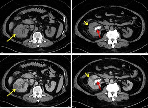 Renal Abscesses Radiology Cases