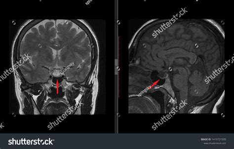 Pituitary Gland Hypophysis Mri Scan Magnetic стоковая иллюстрация