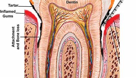 A schematic of the human tooth illustrating the process of periodontal