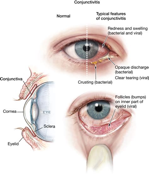Swollen Eyelids Iristech