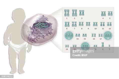 Trisomy 13 Photos And Premium High Res Pictures Getty Images