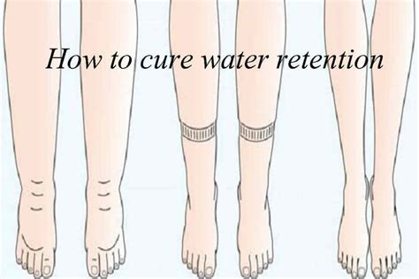 Water Retention Causes Symptoms And Remedies Possible