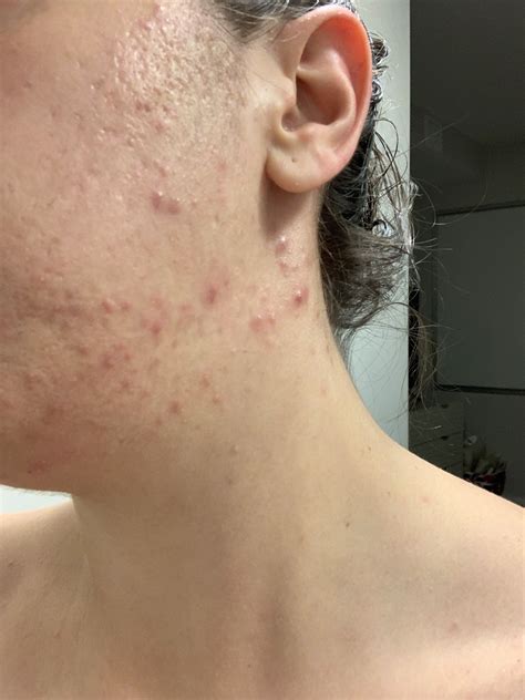 31 Year Old Female Bacterial Acne Or Fungal Pictures General