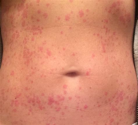 Allergic Reaction Rash Pictures Pictures Photos