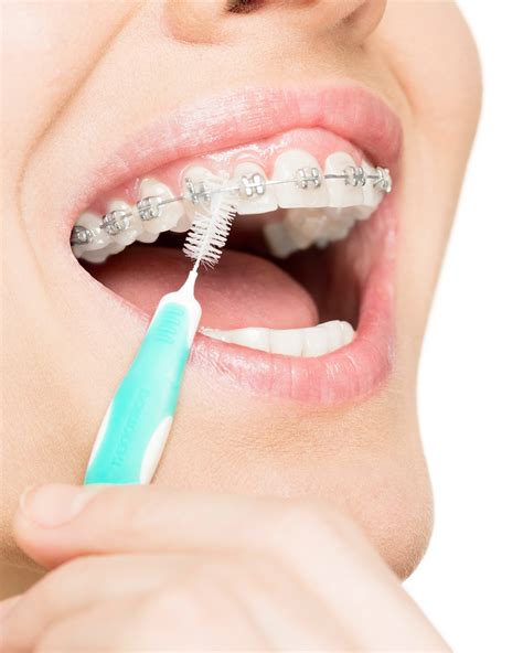 Anyway i'm just wondering how long it takes to be all the way out and if we're in for more pain? DIY Dental Care | How To Clean Braces | DentalPlans.com