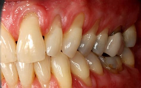 Regenerate Gum And Bone Spring Dental Group