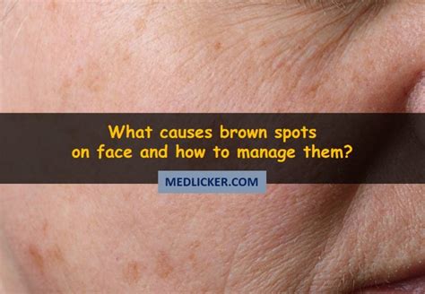 Awesome These 17 Remedies May Help You Deal With Brown Spots On Your Face