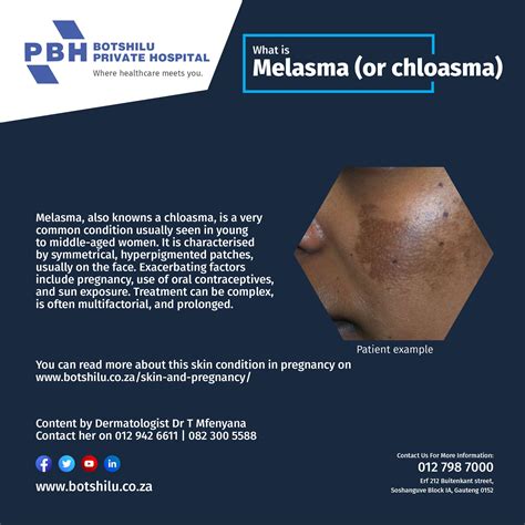 Melasma Or Chloasma Botshilu Private Hospital