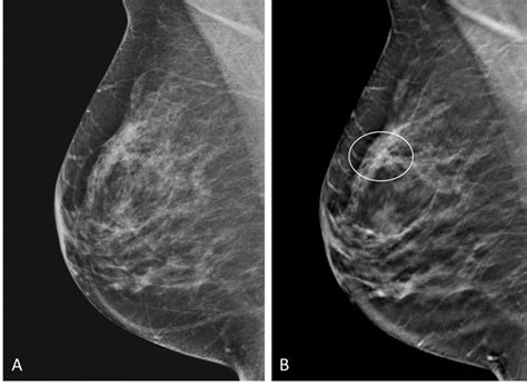 Additional Cancer Screening For Women With Dense Breasts • Healthcare