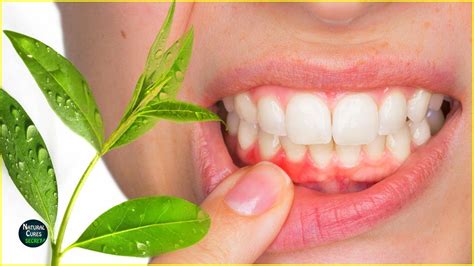 How To Treat Receding Gums At Home Home Remedies For Gum Disease Youtube