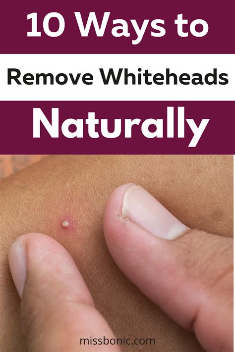 10 Easy Ways To Remove Whiteheads Naturally In 2021 Whiteheads Buy
