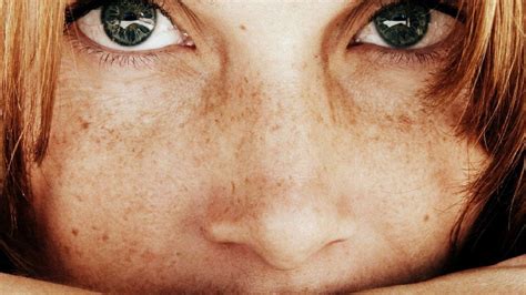 A Genetic Link Between Red Hair Freckles And Skin Cancer Medaxs My
