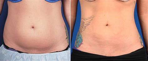 Liposuction Before And After Photos Palm Desert Palm Springs