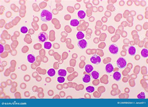 Acute Lymphocytic Leukemia Or All Cells In Blood Smear Stock Photo