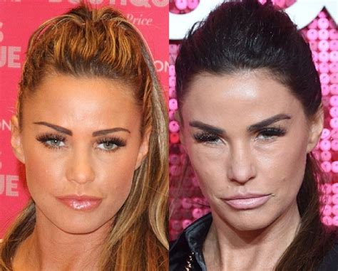 What Happened To Katie Price Lips Did She Do Plastic Surgery Before And After Photos Explored