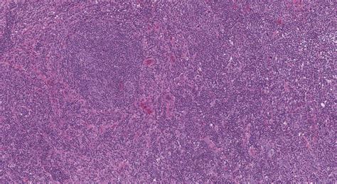 Follicular T Cell Lymphoma Atlas Of Pathology