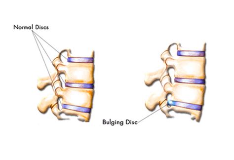 Bulging Disc Bonati Spine Institute
