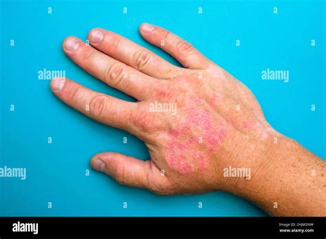 Burns Of Hand Wounds Hand With Sunburn Type Of Burn Stock Photo Alamy