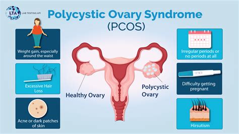 Polycystic Ovary Syndrome Pcos Causes Signs And Symptoms