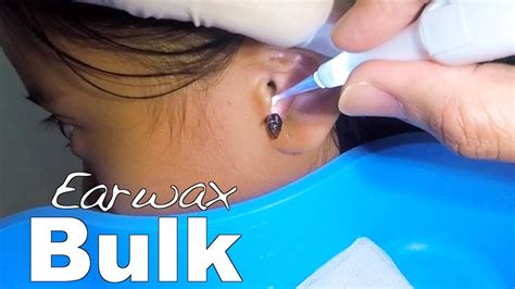 Girls Bulk Earwax Removal Youtube