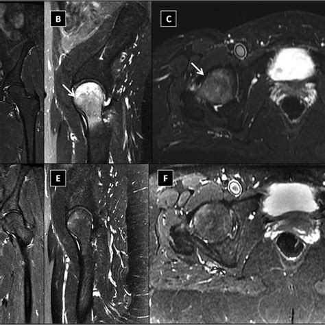 Initial Magnetic Resonance Imaging Mri Study For Both Hip Joints