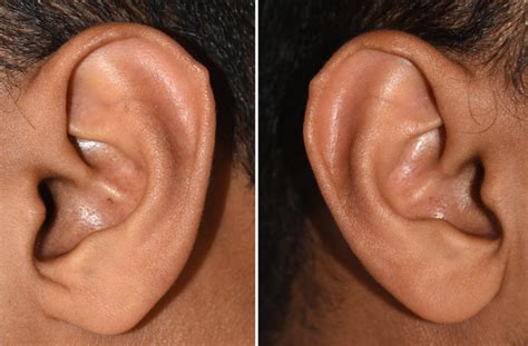 Plastic Surgery Case Study Excision Of Darwins Tubercles Of The Ears