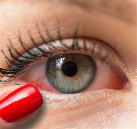 Can Cbd Make Your Eyes Red 27f Chilean Way