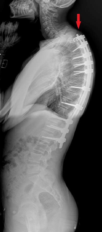 The Lateral Xray Of A Patient With Scheuermanns Kyphosis Who Developed