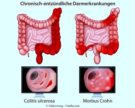 Colitis ulcerosa, Symptome, Rektum, Ernährung, Proktokolitis, Crohn