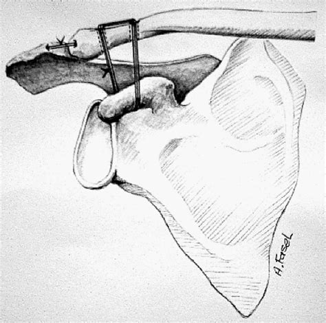 Acromioclavicular And Coracoclavicular Cerclage Reconstruction For