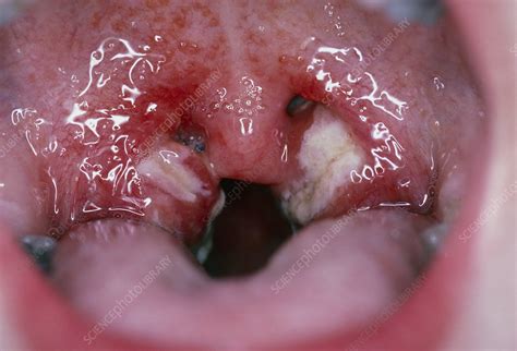 Infected Tonsils Of Patient With Glandular Fever Stock Image M165
