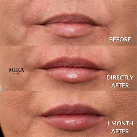 Lip Flip Or Lip Filler Which Option Produces Better Results Mira