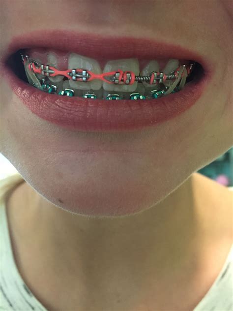 Pin By Jaidyn Coots On Braces Braces Colors Cute Braces Dental Braces