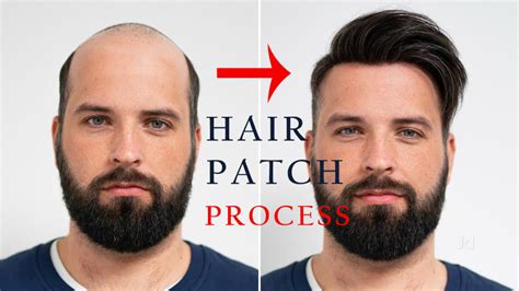 Hair Patch Fixing Complete Procedure Of Hair Patch Fixing Its Methods