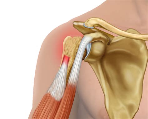 Long Head Of Biceps Tendon Tear Hot Sex Picture
