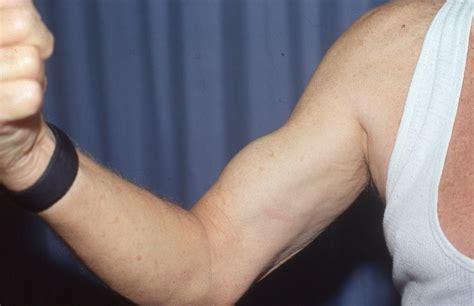 Rupture Long Head Biceps EssentialOrthopedics