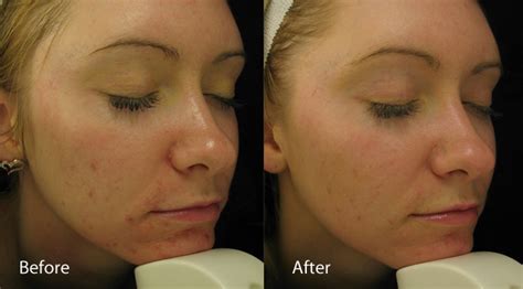 Dermalux Led Phototherapy Treatments Rachel Hunter Beauty Clinic